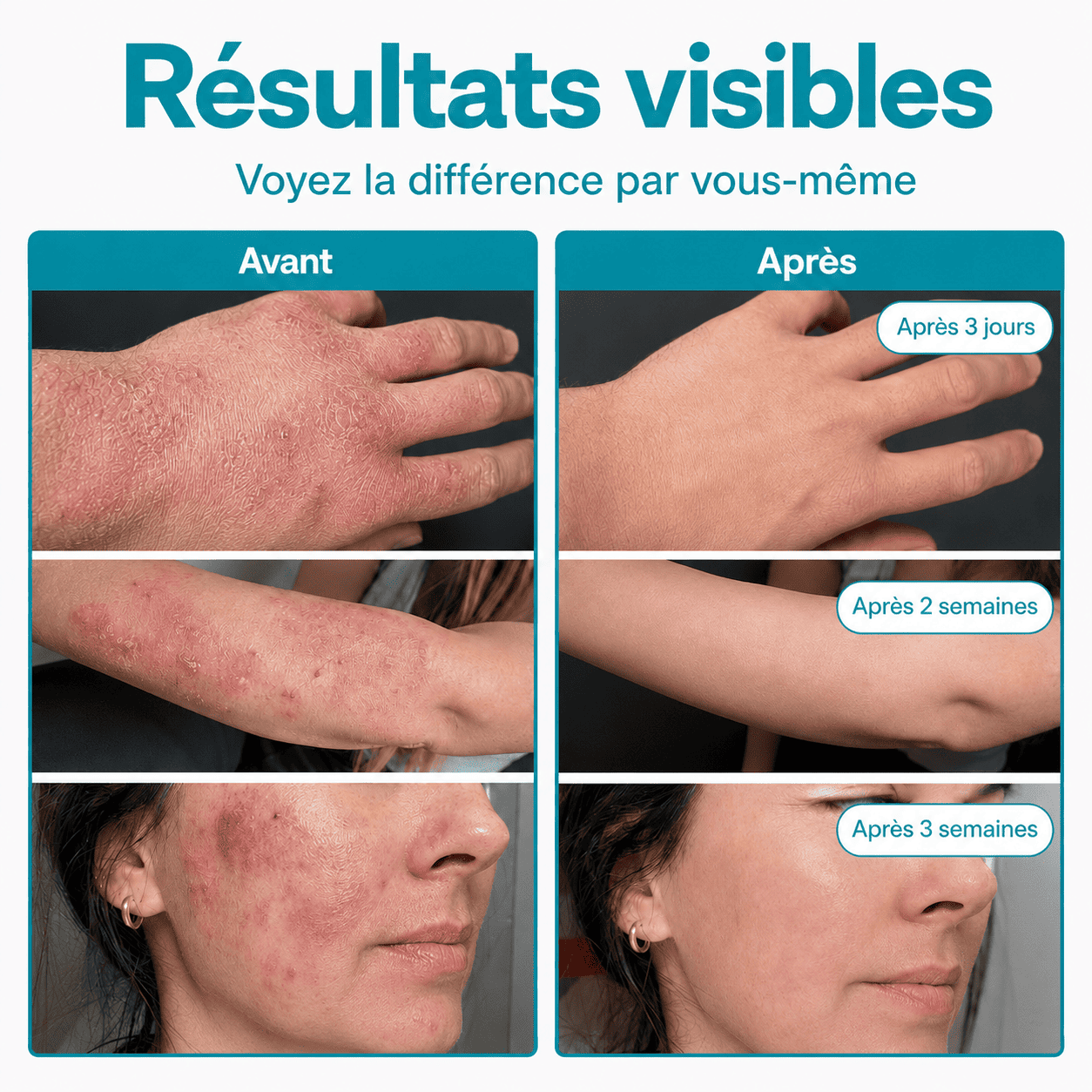Spray SOS : Élimine la bactérie responsable de l'eczéma