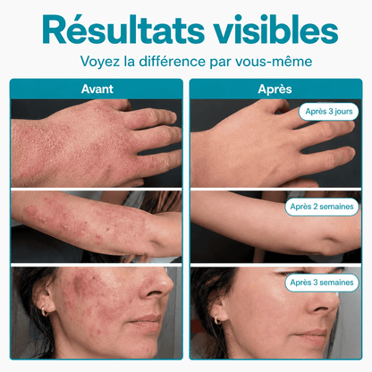 Spray SOS : Élimine la bactérie responsable de l'eczéma